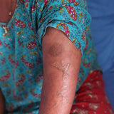 Leprosy Reaction Treatment - Gift of Love (Donation)